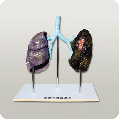폐의비교(정상폐와흡연폐)